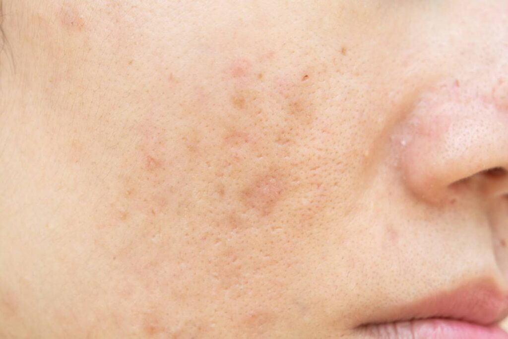 skin Dark Spots